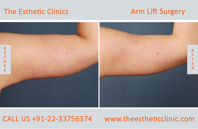 Arm Lift Surgery, Brachioplasty before after photos in mumbai india (1)